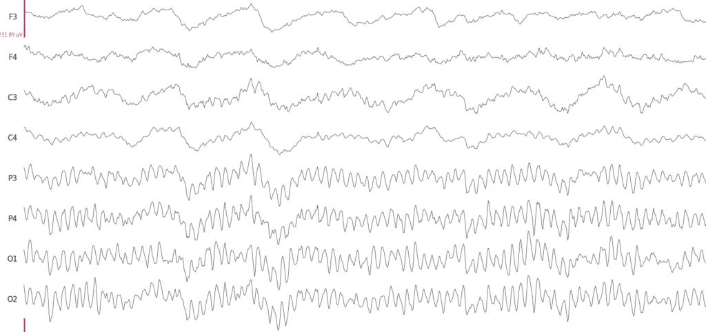 EEG signals when a person has their eyes closed. The alpha rhythm can be observed in P3-O2 electrode recordings, that are over occipital cortex region.