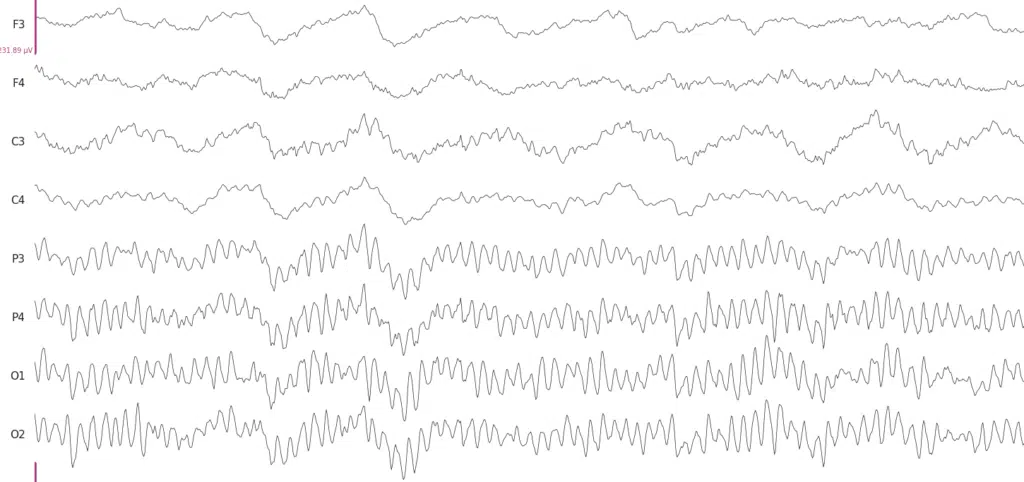 EEG signals when a person has their eyes closed. The alpha rhythm can be observed in P3-O2 electrode recordings, that are over occipital cortex region.