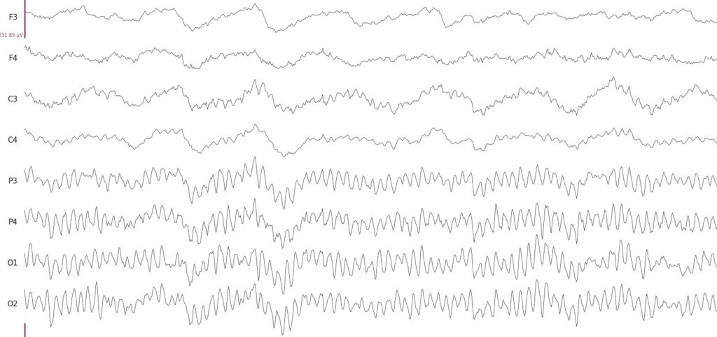 EEG signals when a person has their eyes closed. The alpha rhythm can be observed in P3-O2 electrode recordings, that are over the occipital cortex region