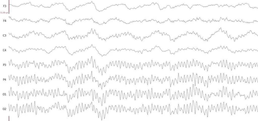 EEG (Electroencephalography) - BrainAccess